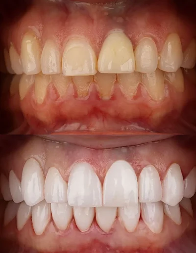 Hollywood dentist for smile design